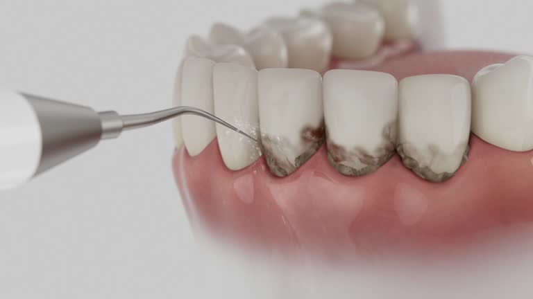 Trusted Dental Implants service in Miamisburg, OH - Dentist Open Now